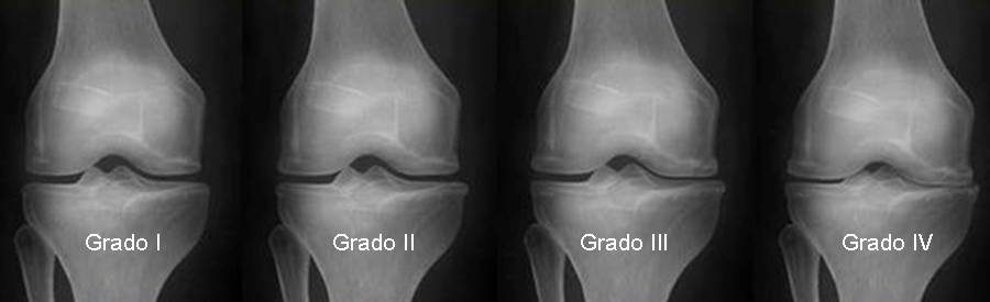 Artrosis de rodilla: por qué ocurre, cómo identificarla y cómo puede ayudarte la fisioterapia